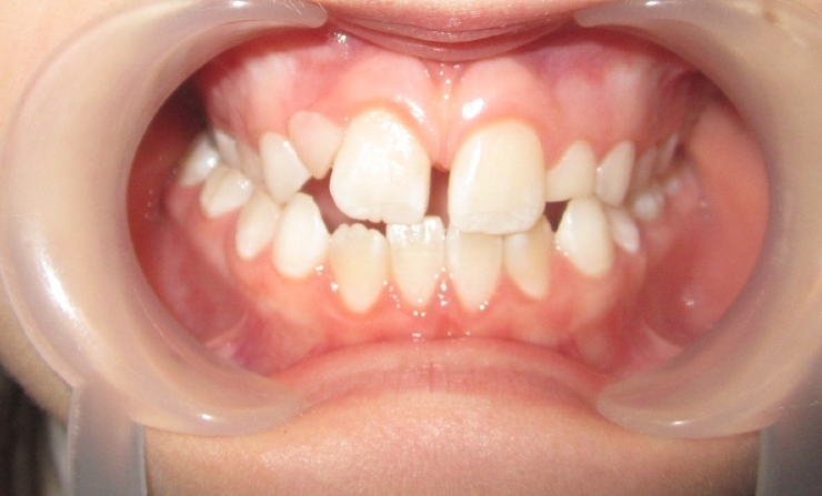 Before orthodontics