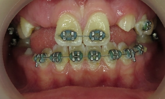 During orthodontics